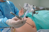 Лапароскопия в гинекологии