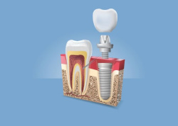 Дентальная имплантация: новые зубы уже через 4-6 месяцев!